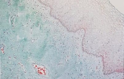 Lipogems® pour le traitement de l'atrophie urogénitale - AICPE 2018