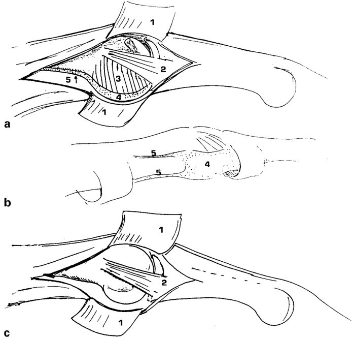 Key visual for the-treatment-of-chronic-flexion-contractures-of-the-proximal-interphalangeal-joint