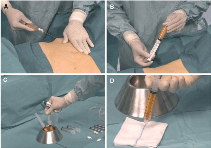 Key visual for micro-fragmented-adipose-tissue-injection-for-the-treatment-of-complex-anal-fistula-a-pilot-study-accessing-safety-and-feasibility