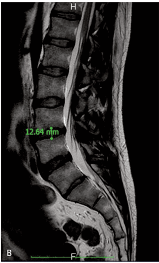 Key visual for low-back-pain-treated-with-disc-decompression-and-autologous-micro-fragmented-adipose-tissue-a-case-report