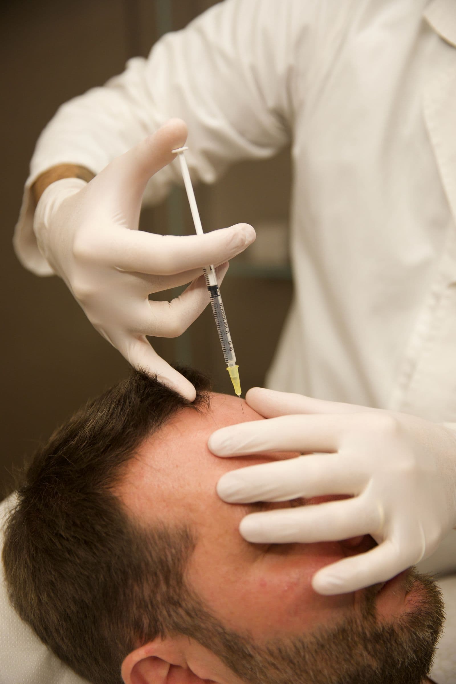 Caduta di capelli? L'efficacia dell'Hair Filler: recensioni e opinioni