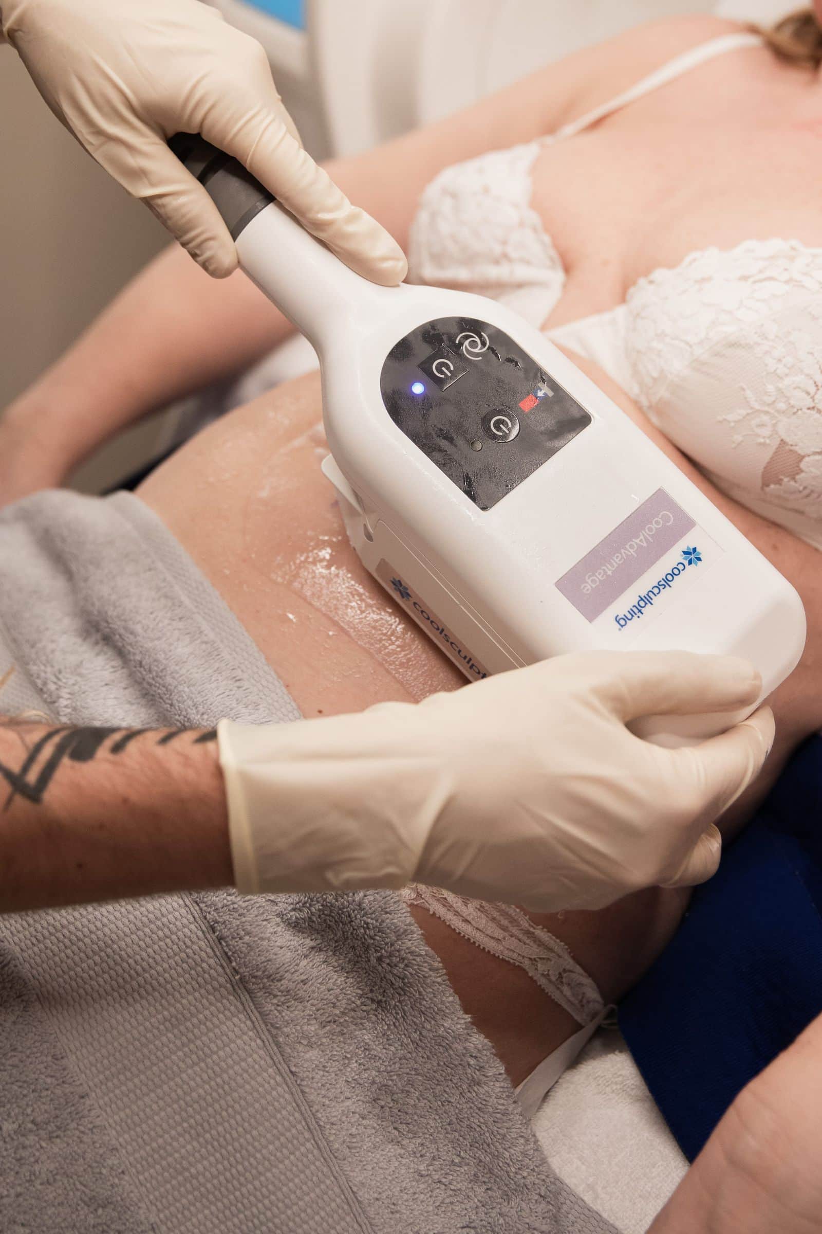 CoolSculpting: Sedute Necessarie e Zone Trattabili
