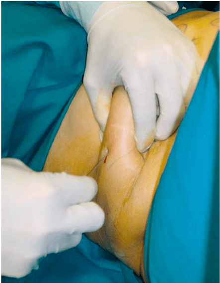 Key visual for intersphincteric-anal-lipofilling-with-micro-fragmented-fat-tissue-for-the-treatment-of-faecal-incontinence-preliminary-results-of-three-patients