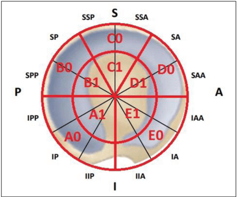 Key visual for micro-fragmented-adipose-tissue-transplantation-matt-for-the-treatment-of-acetabular-delamination-a-two-years-follow-up-comparison-study-with-microfractures
