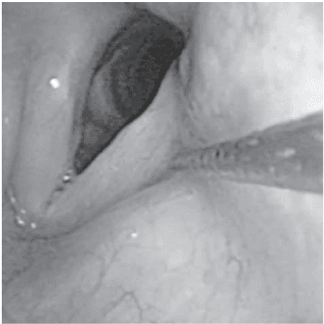 Key visual for transnasal-endoscopic-microfractured-fat-injection-in-glottic-insufficiency