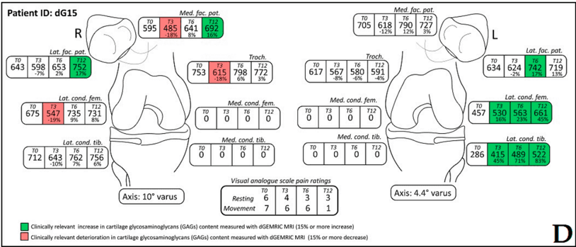 Key visual for the-effect-of-intra-articular-injection-of-autologous-microfragmented-fat-tissue-on-proteoglycan-synthesis-in-patients-with-knee-osteoarthritis