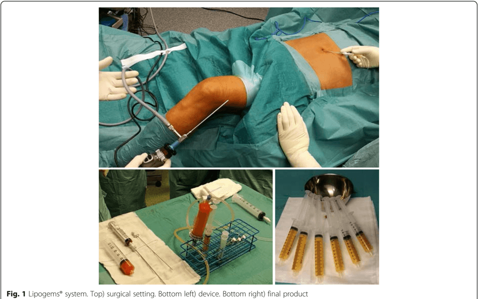 Key visual for autologous-and-micro-fragmented-adipose-tissue-for-the-treatment-of-diffuse-degenerative-knee-osteoarthritis