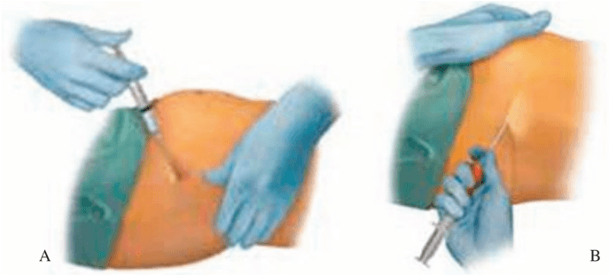 Key visual for injection-of-autologous-micro-fragmented-adipose-tissue-for-the-treatment-of-post-traumatic-degenerative-lesion-of-knee-cartilage-a-case-report