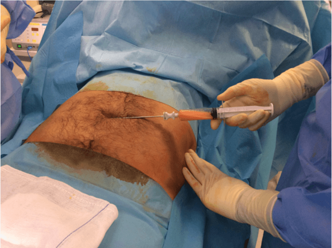 Key visual for autologous-microfractured-and-purified-adipose-tissue-for-arthroscopic-management-of-osteochondral-lesions-of-the-talus