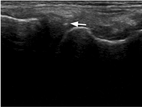 Key visual for clinical-evaluation-of-micro-fragmented-adipose-tissue-as-a-treatment-option-for-patients-with-meniscus-tears-with-osteoarthritis-a-prospective-pilot-study