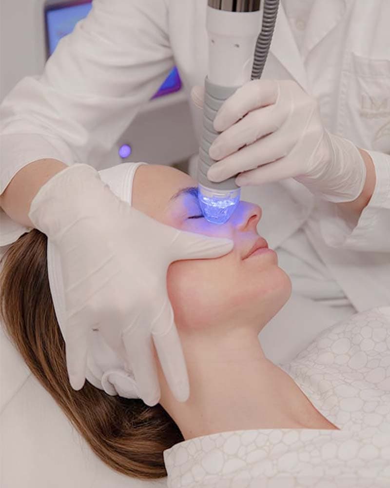 Vivace RF Microneedling