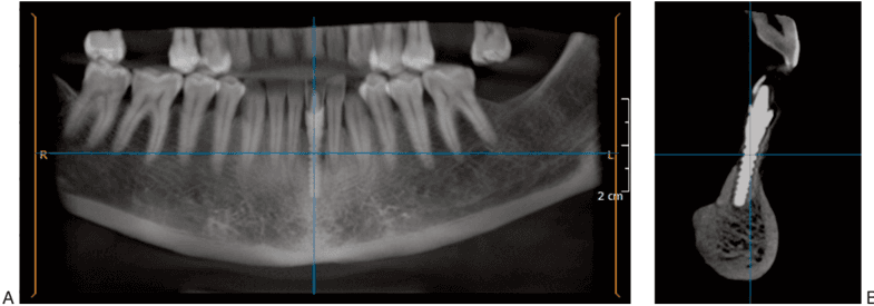 Key visual for microfractured-lipoaspirate-may-help-oral-bone-and-soft-tissue-regeneration-a-case-report