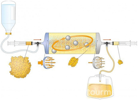 Key visual for rectal-advancement-flap-plus-adipose-lipofilling-rafal-for-the-treatment-of-rectourethral-fistulas-after-radical-prostatectomy