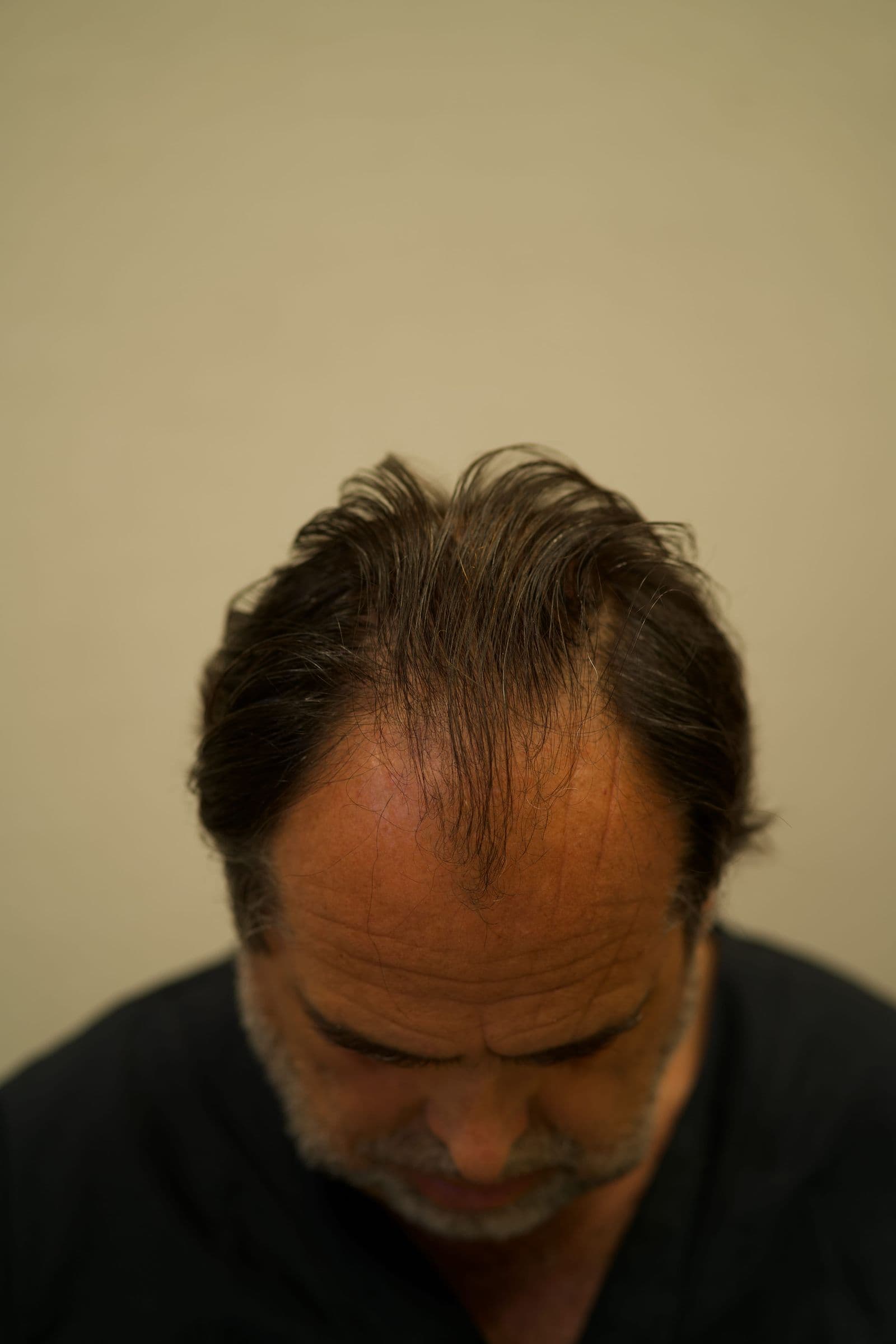 Rimedi per contrastare la perdita di capelli