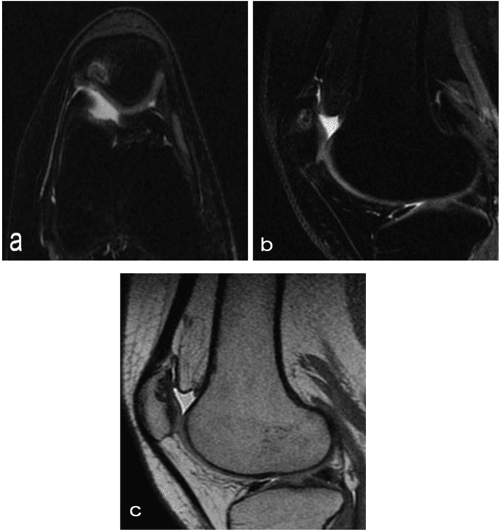 Key visual for the-effect-of-autologous-adipose-derived-mesenchymal-stem-cell-therapy-on-juvenile-osteochondritis-dissecans-of-the-patella-a-case-study