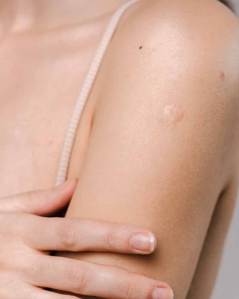 Scars Improvement