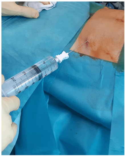 Key visual for intraarticular-injection-of-microfragmented-adipose-tissue-plus-arthroscopy-in-isolated-primary-patellofemoral-osteoarthritis-is-clinically-effective-and-not-affected-by-age-bmi-or-stage-of-osteoart