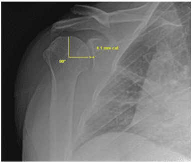 Key visual for clinical-use-of-autologous-micro-fragmented-fat-progressively-restores-pain-and-function-in-shoulder-osteoarthritis