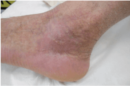 Key visual for utilizzo-di-staminali-da-tessuto-adiposo-nelle-lesioni-cutanee-croniche-esperienza-clinica