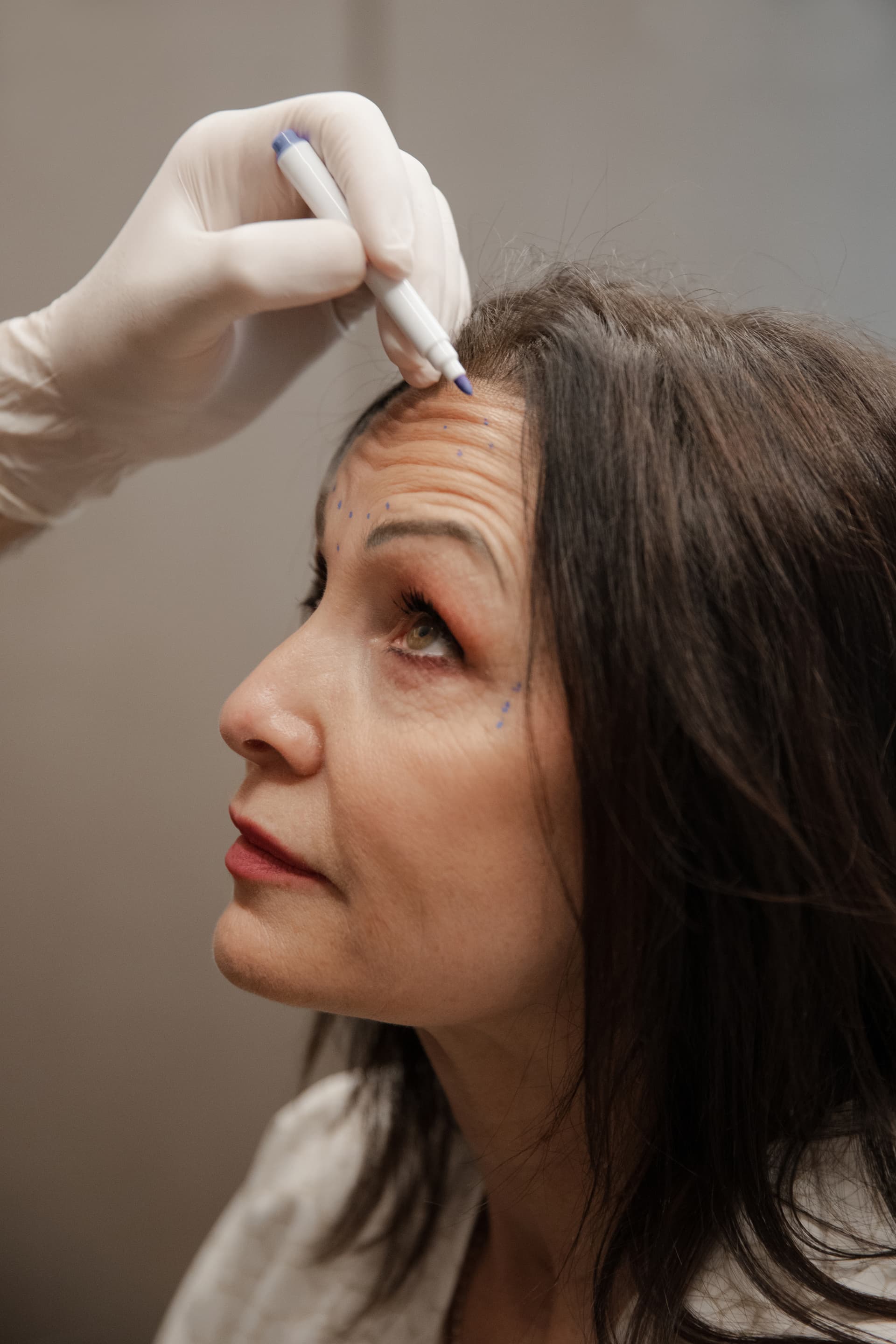 Come funziona il Botox per le rughe? Efficacia e Tempi