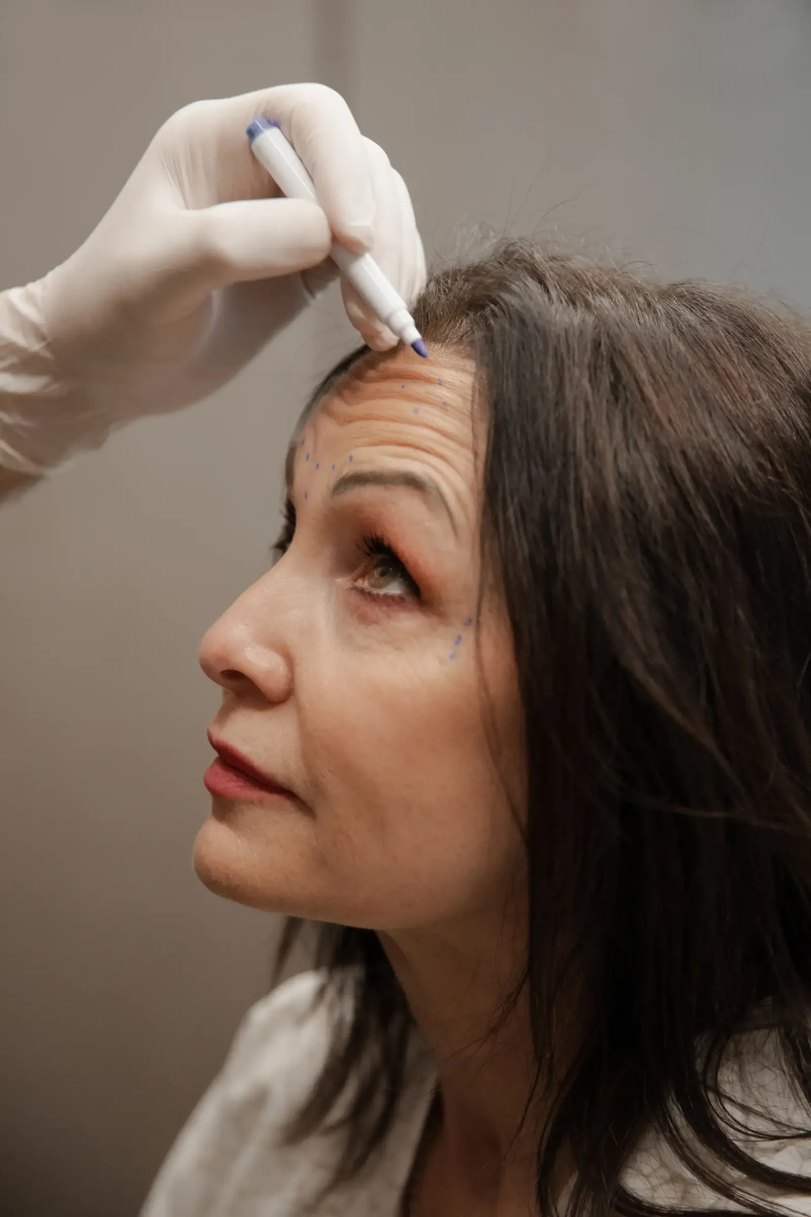 Come funziona il Botox per le rughe? Efficacia e Tempi