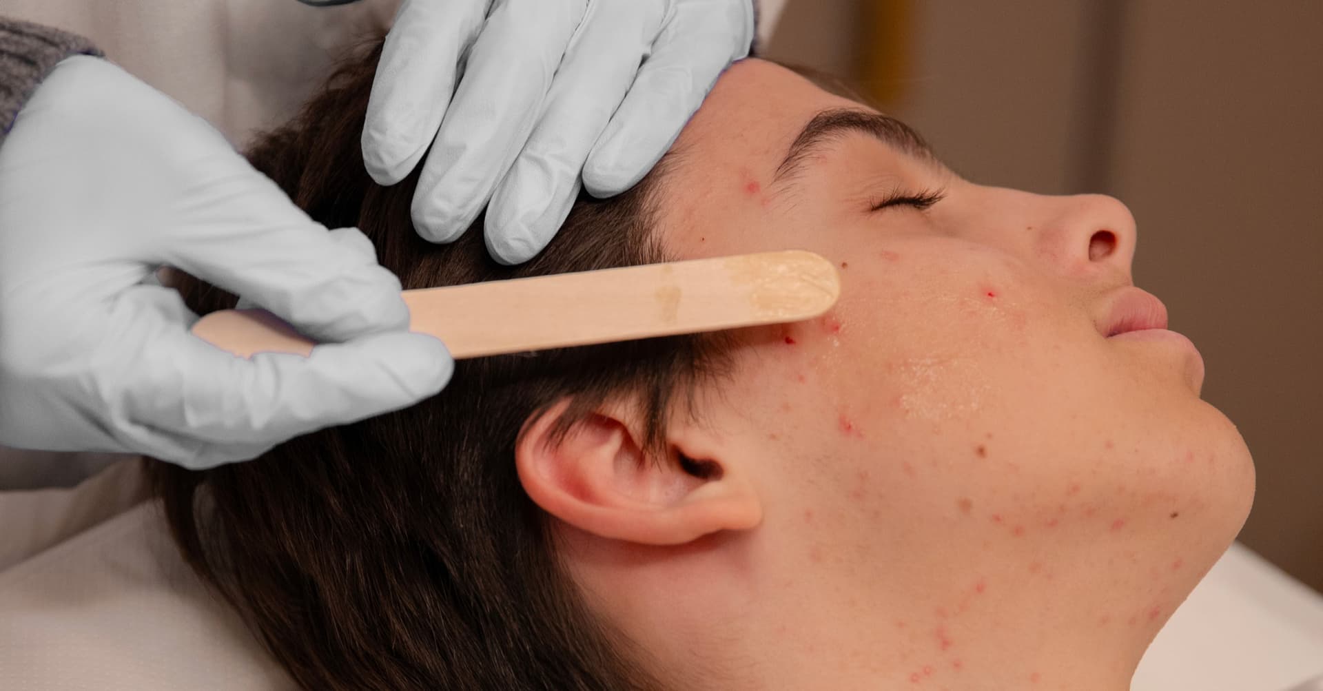 cause-e-sintomi-acne