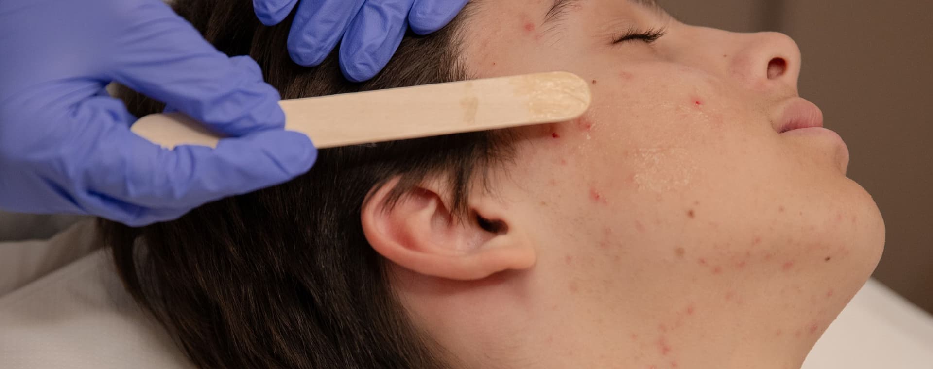 cause-pelle-butterata