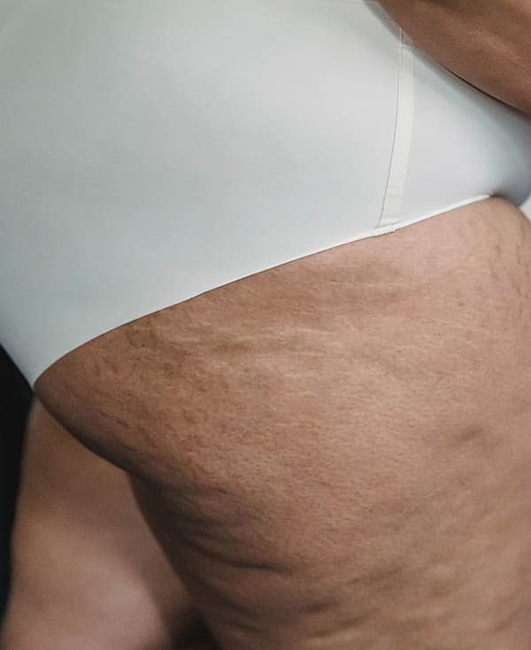 Cellulite-Reduktion