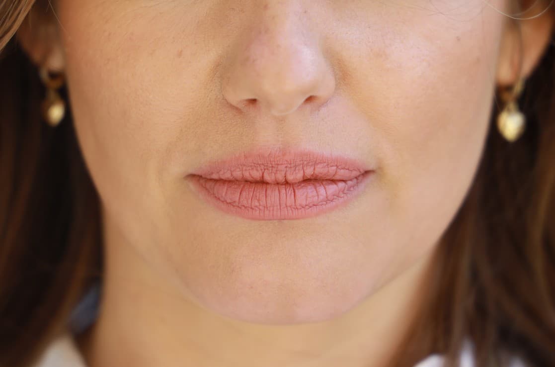 How to eliminate lip contour wrinkles with hyaluronic acid?