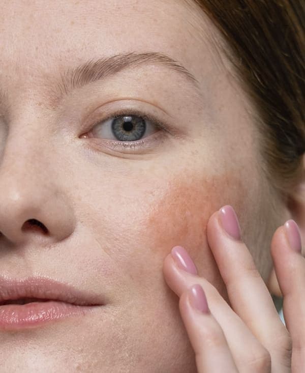 Facial Redness