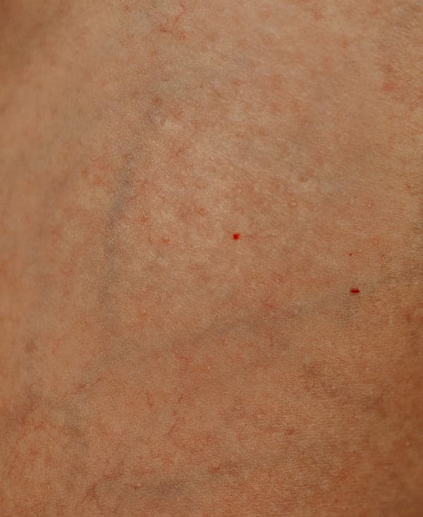 Spider Veins and Varicose Veins