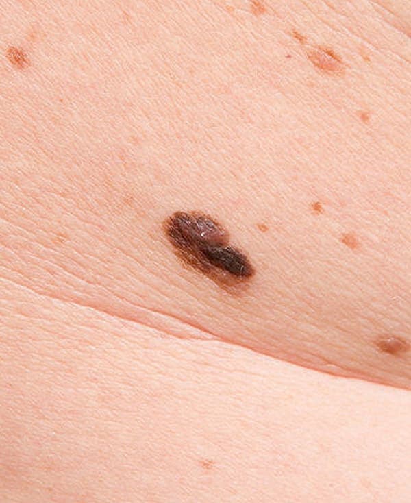 Melanoma