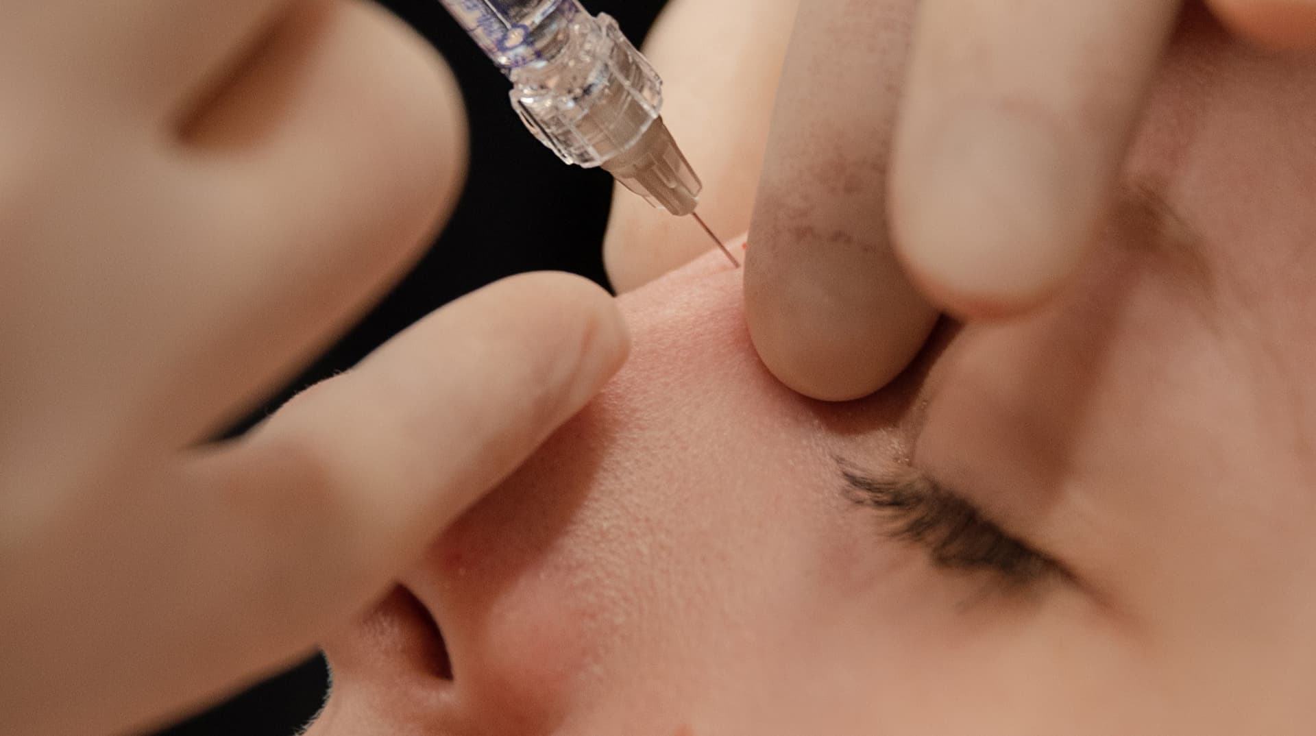 rinofiller-come-funziona