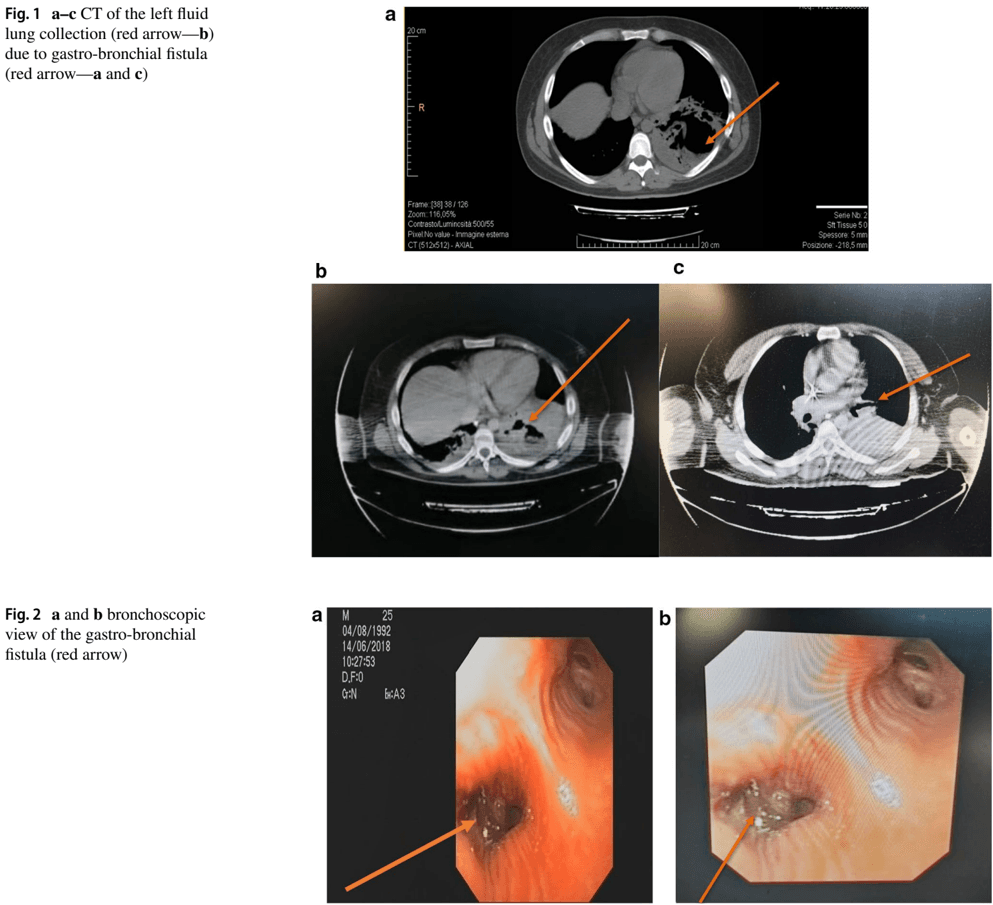 Key visual for stemming-the-leak-a-novel-treatment-for-gastro-bronchial-fistula