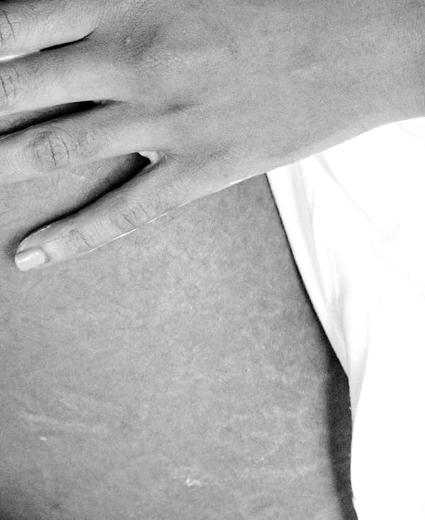 Stretch Mark Minimization