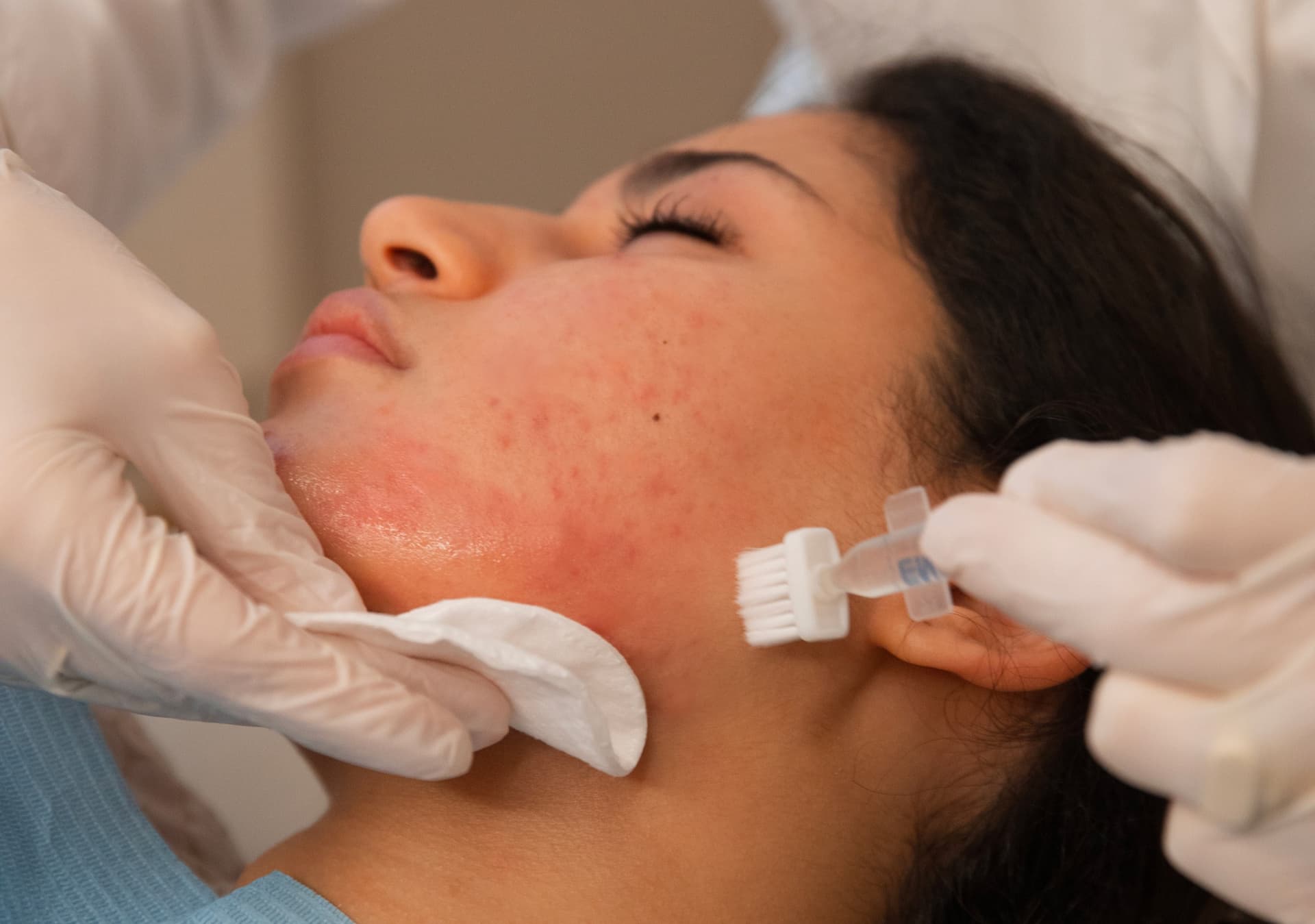 togliere-acne-attiva