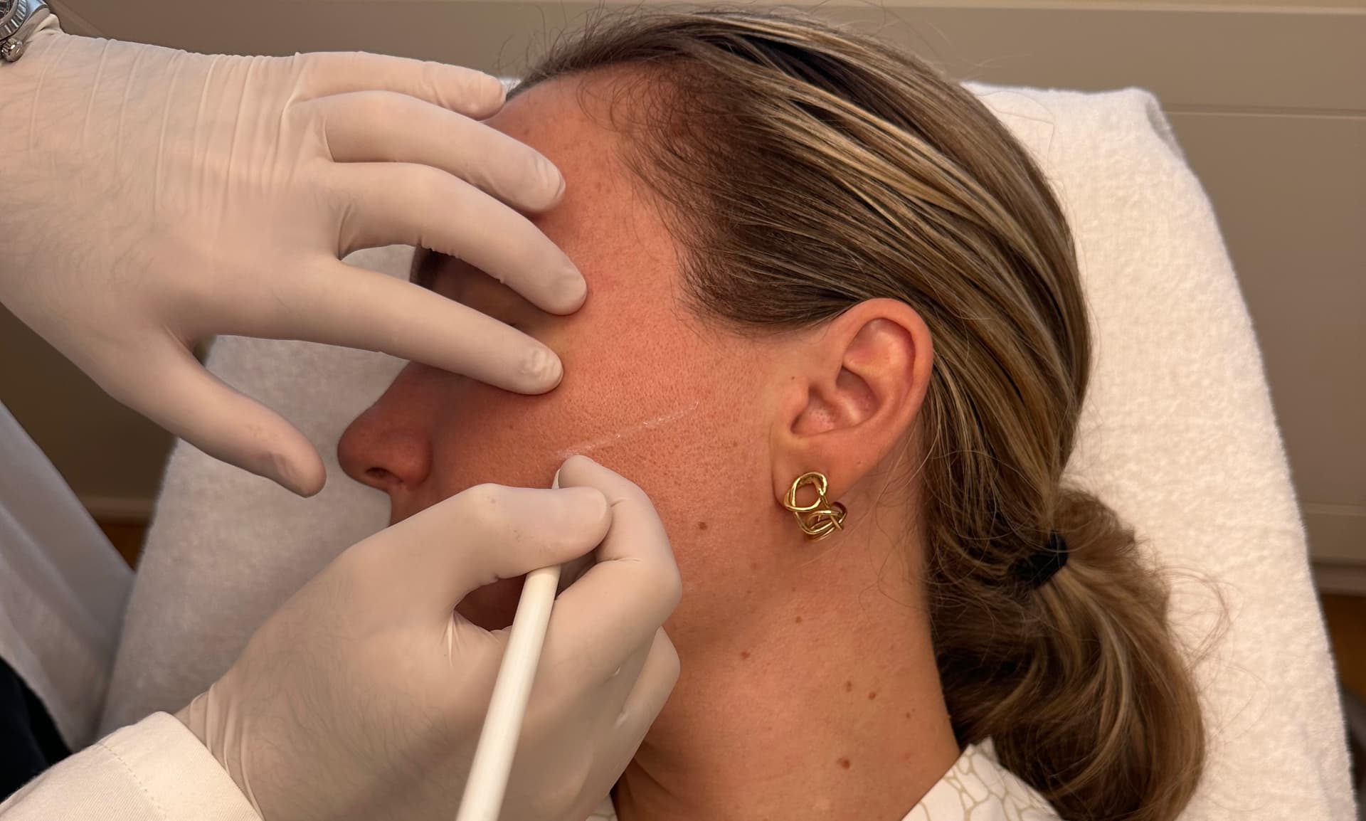 trattamenti-lifting-non-chirurgico