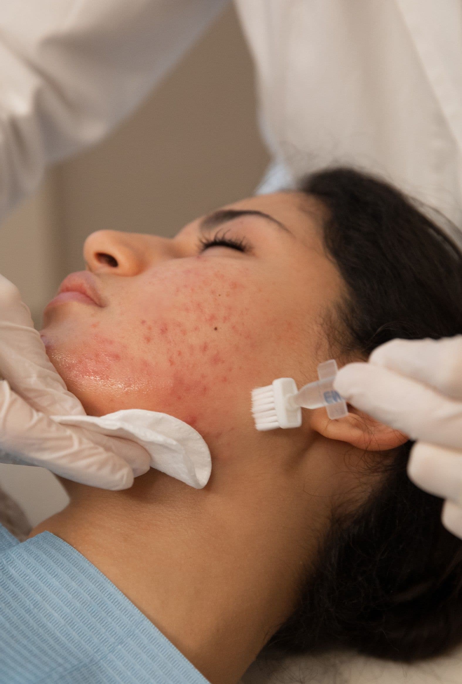 Peau du visage Grêlée : comment éliminer les trous du visage ?