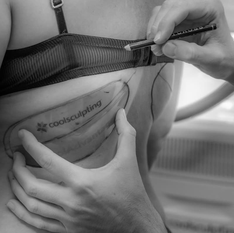 Q&A: Is Coolsculpting Comparable to Liposuction?