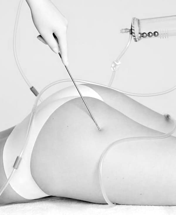 Case Study: Lipoaspiration vs Liposuction - Understanding the Difference