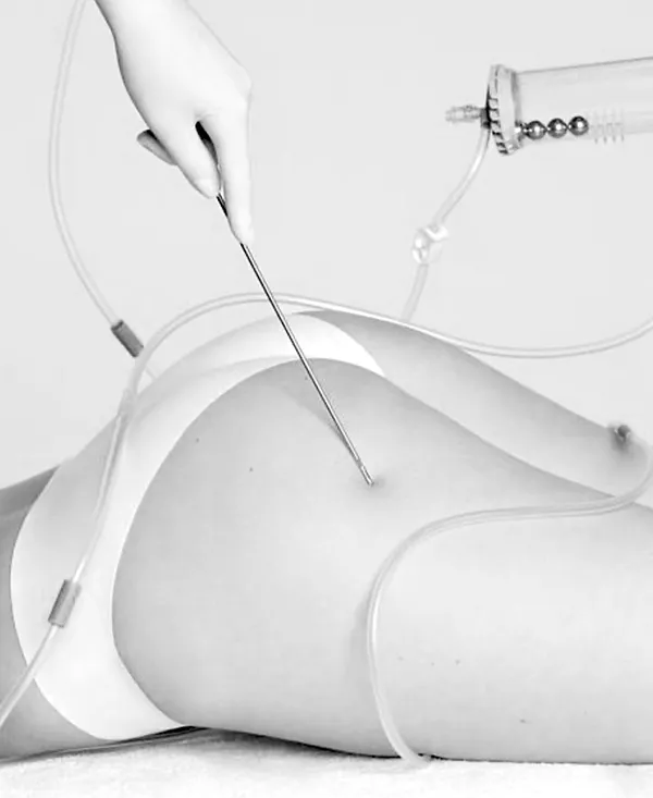 Étude de Cas: Lipoaspiration vs Liposuccion - Comprendre la Différence