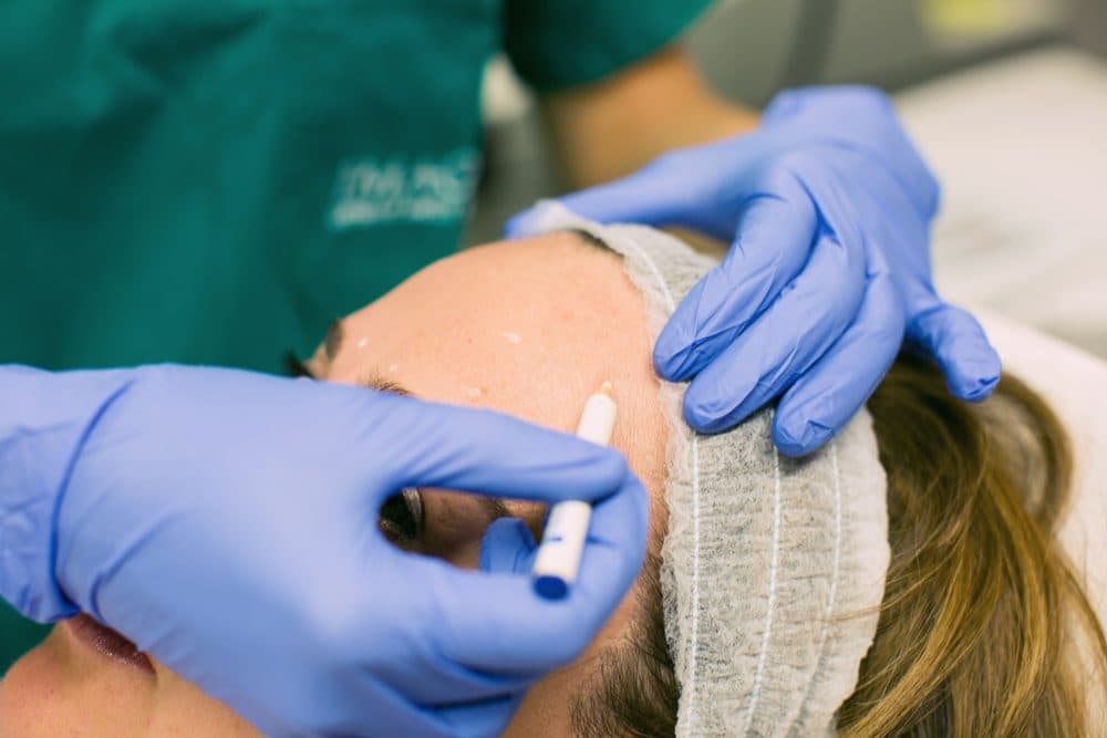 Global Facial Rejuvenation: The Full-Face Approach