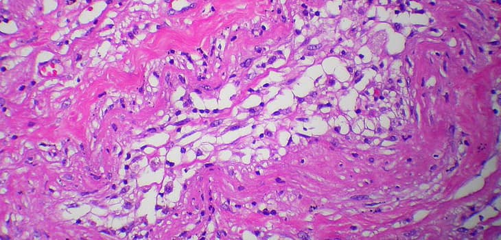 Orthopedic Lipogems - The New Frontier in Sports Medicine