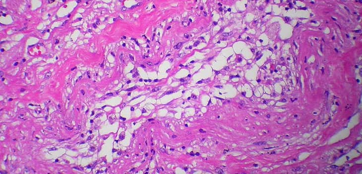 Orthopädisches Lipogems® - Die Neue Grenze in der Sportmedizin