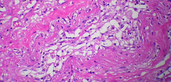 Orthopädisches Lipogems® - Die Neue Grenze in der Sportmedizin