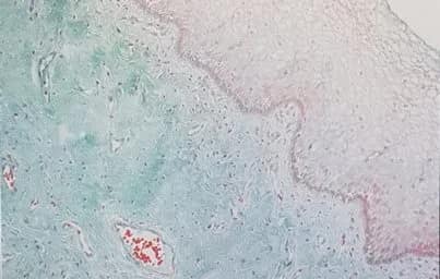 Lipogems® zur Behandlung urogenitaler Atrophie - AICPE 2018