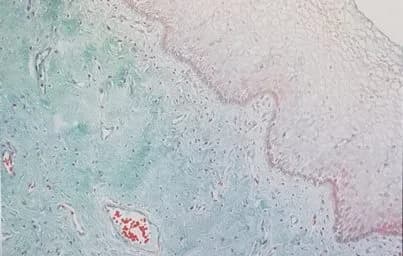 Lipogems® pour le traitement de l'atrophie urogénitale - AICPE 2018