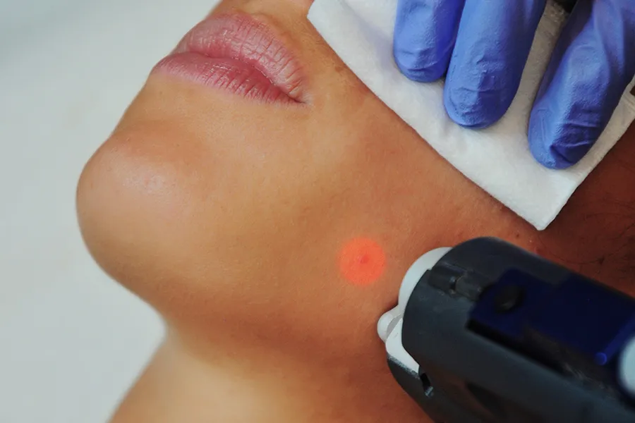 Melasma und Dunkle Flecken: Ihre Entfernung War Noch Nie So Einfach