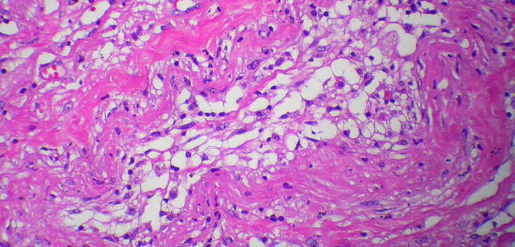 Orthopedic Lipogems - The New Frontier in Sports Medicine